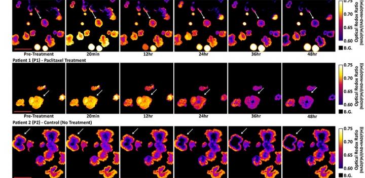 Treatment-Induced Changes in Patient-Derived Cancer Organoid
