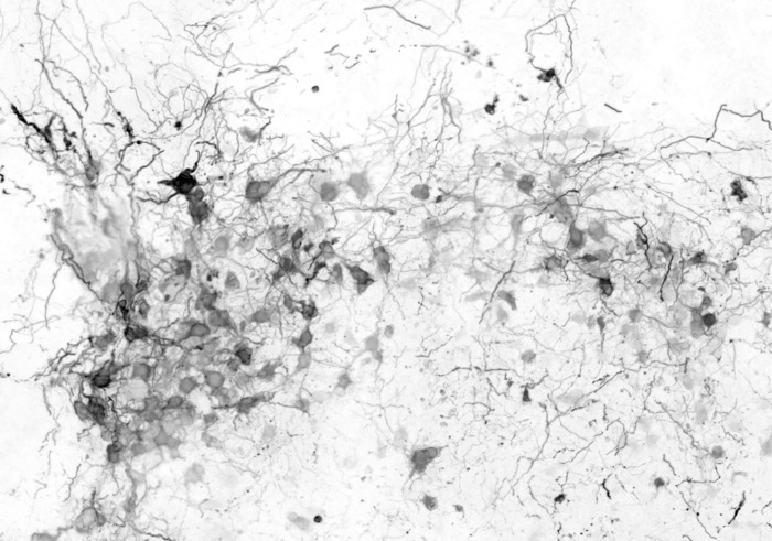 Aggregates of dysmorphic interneurons in TSC patient-derived brain organoids