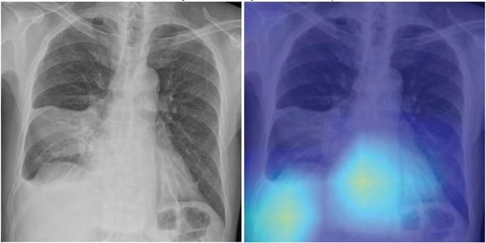 69-year-old male patient with CAP