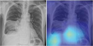 69-year-old male patient with CAP