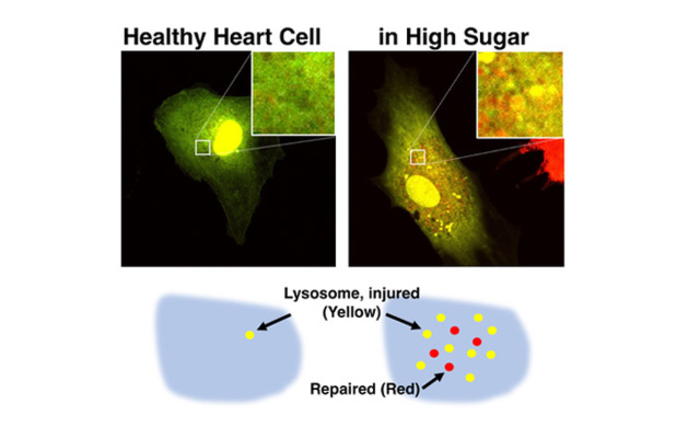 Impact of High Blood Sugar on Lysosomes