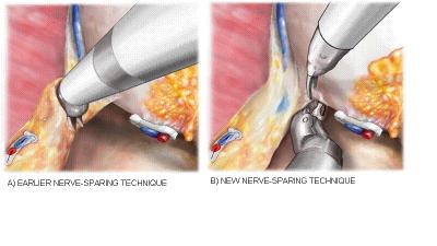 Nerve-Sparing Techniques