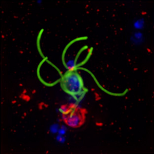 Human red blood cells infected with malaria parasite