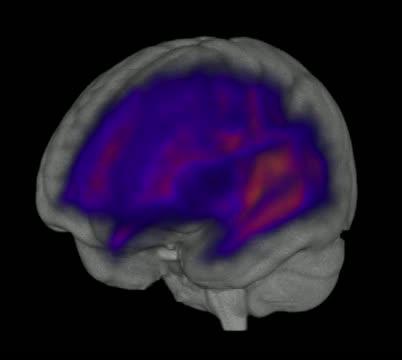 White matter density