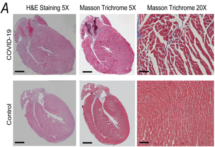 How COVID-19 Can Impact the Heart