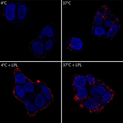 Breast Cancer Cells Taking up Fat Particles