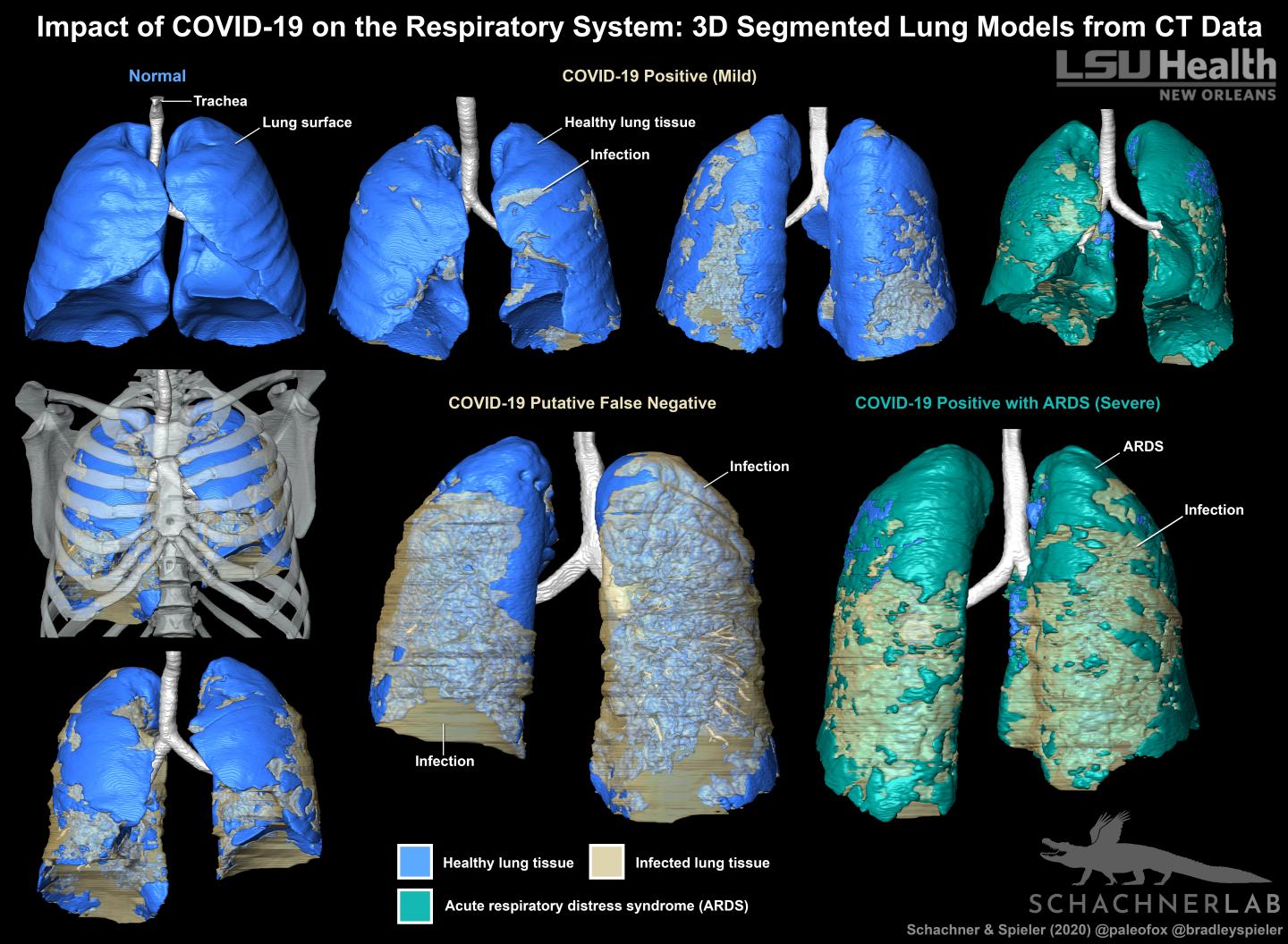 3D Segmented Lung Models of COVID-19 from CT Data