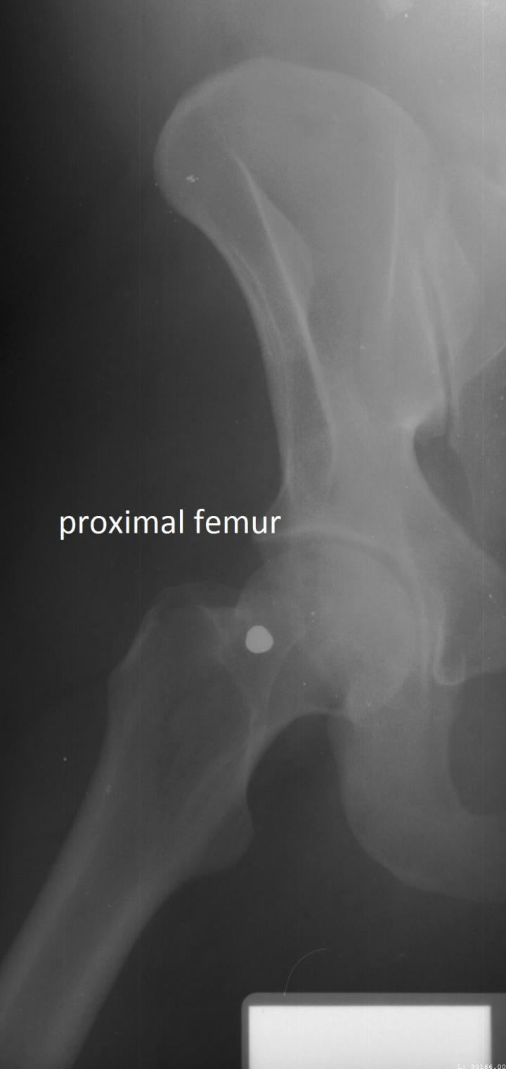 X-Ray of a Proximal Femur