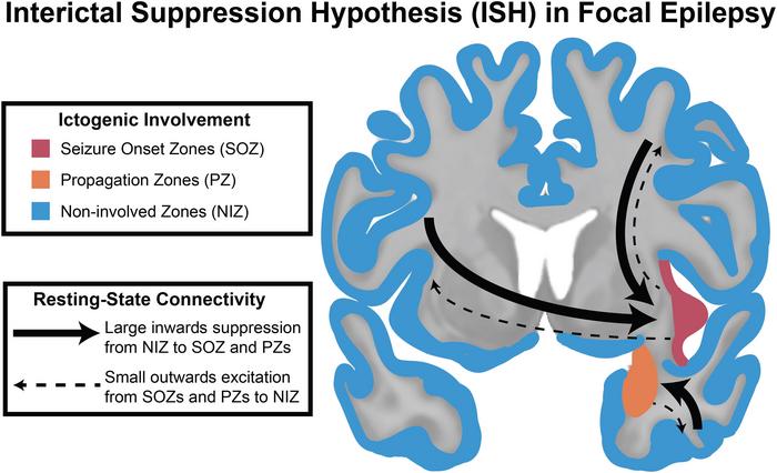 Interictal Suppression Hypothesis (ISH) in Focal Epilepsy