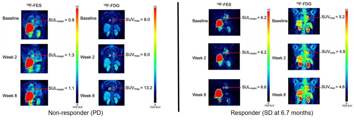 Images of Patients with ER+/PR+/HER2- Invasive Ductal Carcinoma