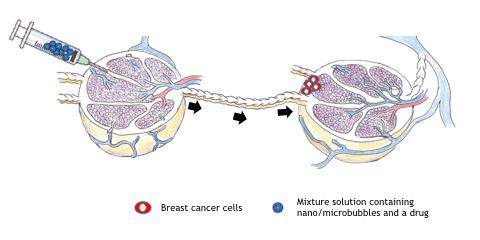 Attacking Metastatic Breast Cancer with Sound