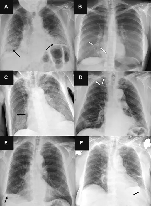 Representative chest radiographs in six patients show (A, C, E) false-positive findings and (B, D, F) false-negative findings as identified by the artificial intelligence (AI) tools.