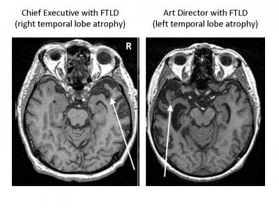 FTLD Patient Brain Images