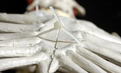 Student-invented Heart Surgery Device