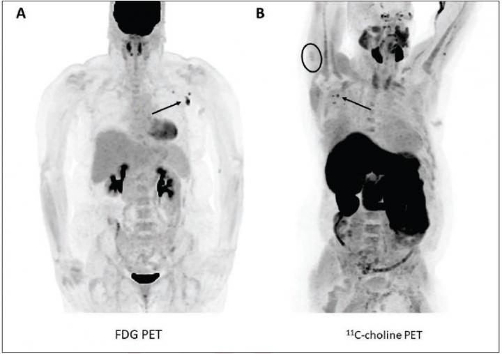 Maximum intensity projection PET images showing  ipsilateral axillary lymph node uptake using two different radiotracers