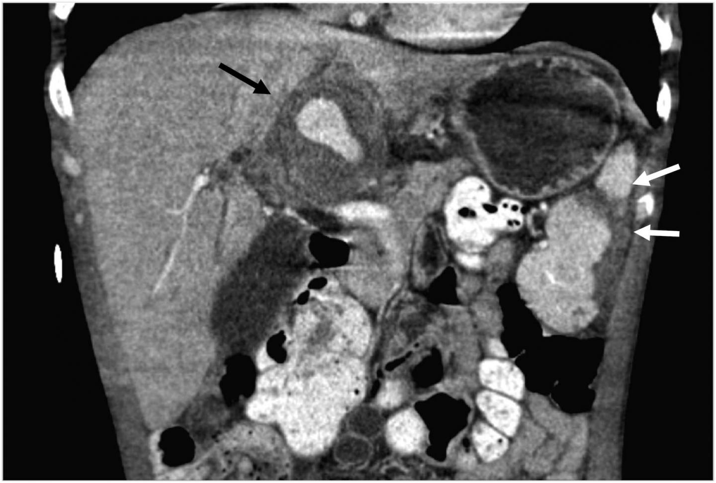 Emergency Radiologists See Inner Toll of Opioid Use Disorders (3 of 3)