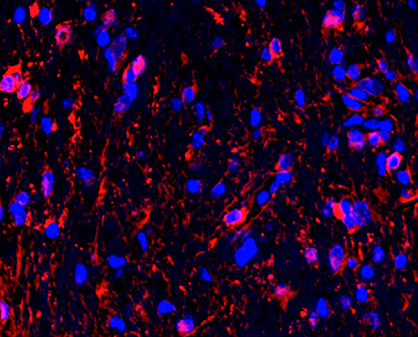 Neural Stimulation of Optic Nerve Gliomas