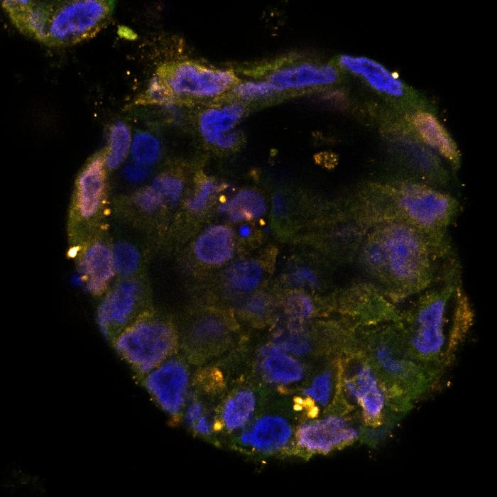 Organoid of a patient with colon cancer