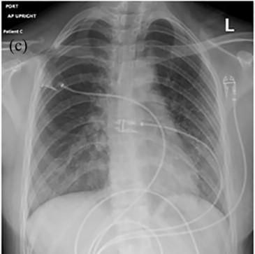 Chest X-ray