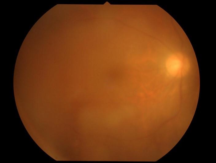 Figure1.Imaging of HTLV-1 uveitis.