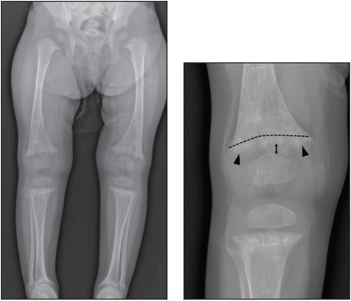 21-month-old girl with rickets and vitamin D level of 5 ng/mL