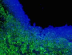 Toxin-Producing Stem Cells Vs. Brain Tumor Cells
