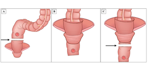3. Main surgical procedures of specimen extraction in extraction-resection technique of transanal NOSES.