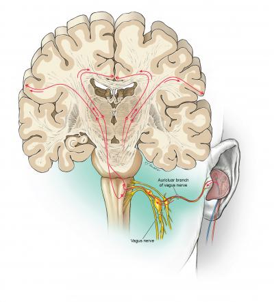 Non-Invasive Vagus Nerve stimulation Devices: Technology