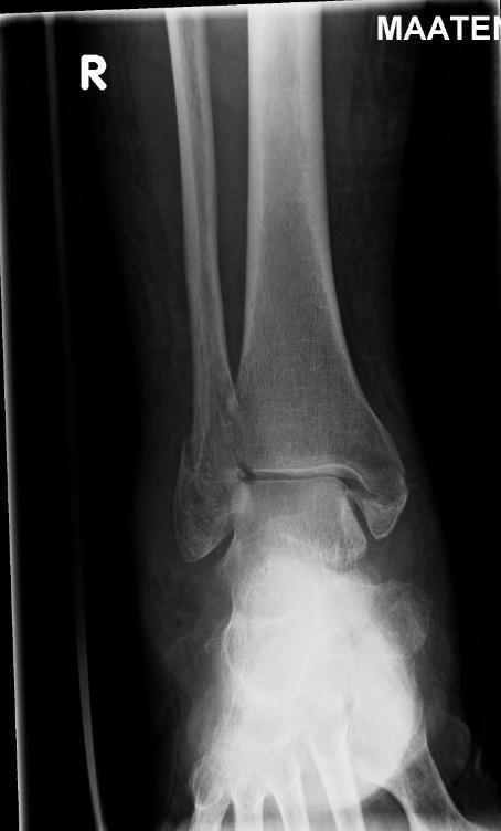 Fractured Ankle