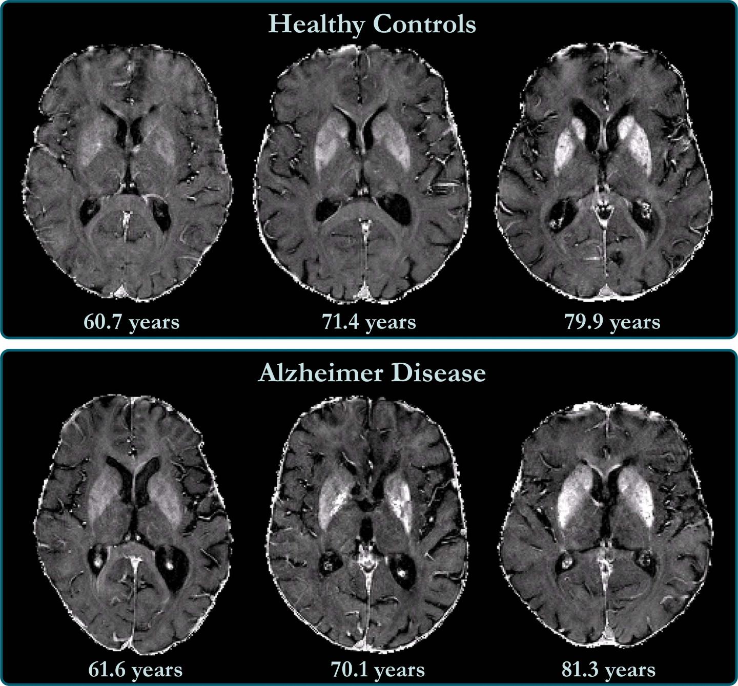 Brain Iron Accumulation Linked to Cognitive Decline in Alzheimer's Patients