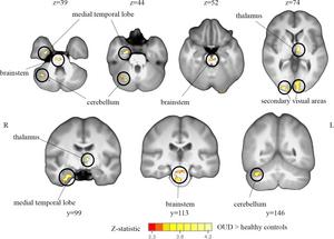 Intrinsic connectivity distribution analysis of resting-state functional MRI scans shows a comparison of global resting-state functional connectivity between participants with opioid use disorder and healthy control participants