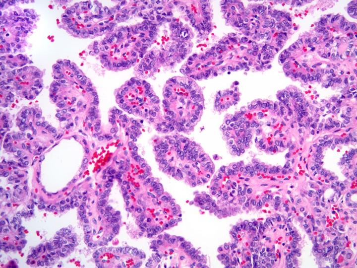 Thyroid Cancer (1 of 3)