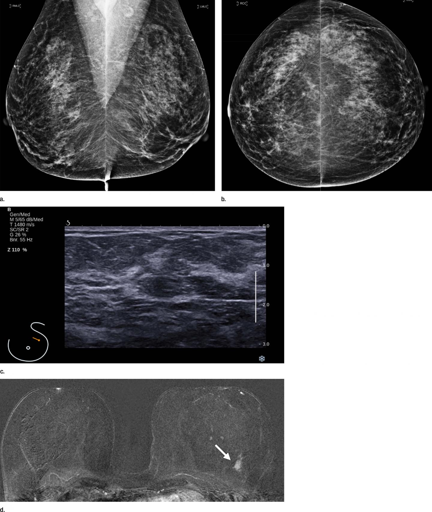 Dense breasts on a mammogram? What to know and do - Harvard Health