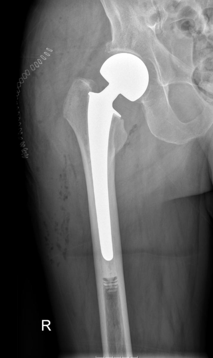 Many diseases increase the risks of hip fract EurekAlert!