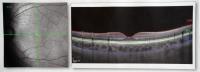 Defining Retinal and Choroid Tissue Boundaries