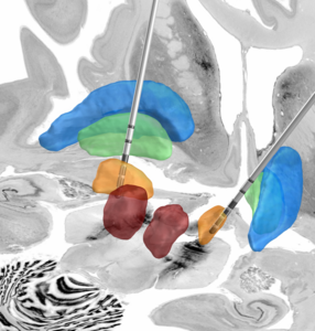 Deep brain stimulation in patients with Parkinson