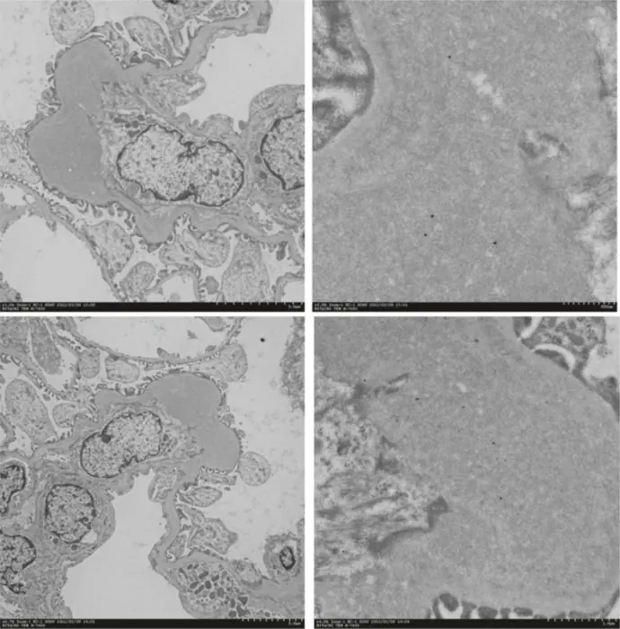 Uncovering the pathogenesis of IgA nephropathy (IgAN)