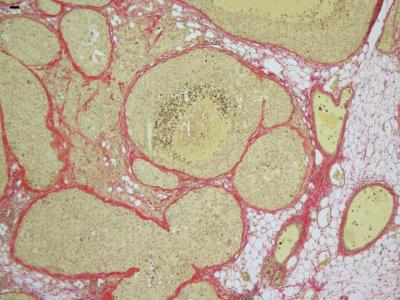 Hormone Receptor Positive Breast Cancer