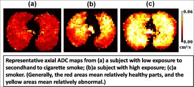 Diffusion MRI Provides Evidence of Lung Injury