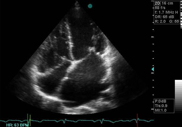 A New Tool to Determine Cost-Effective Control of Rheumatic Heart Disease
