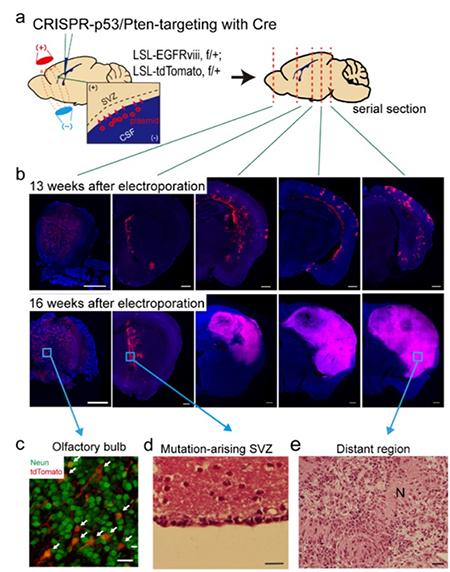 Figure 2 Glioma Progression