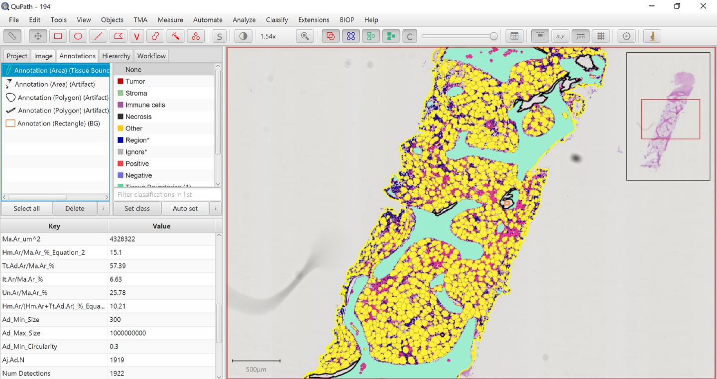 A screenshot of MarrowQuant annotating a bone marrow trephine biopsy from a patient surfing from chemotherapy-induced aplasia.