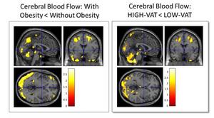 Cerebral Blood Flow
