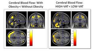 Cerebral Blood Flow