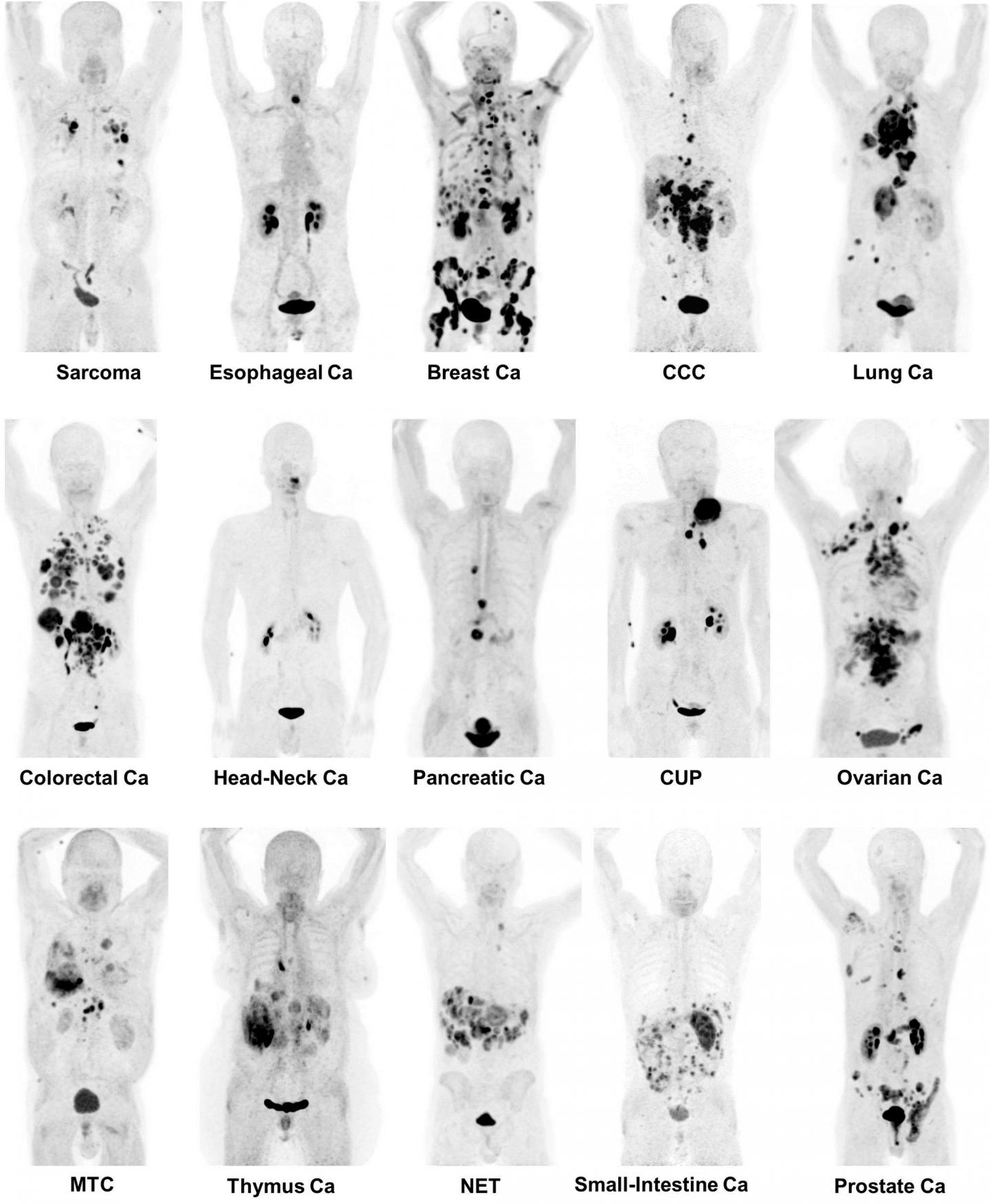 68Ga-FAPI PET/CT in Patients Reflecting 15 Different Tumor Entities