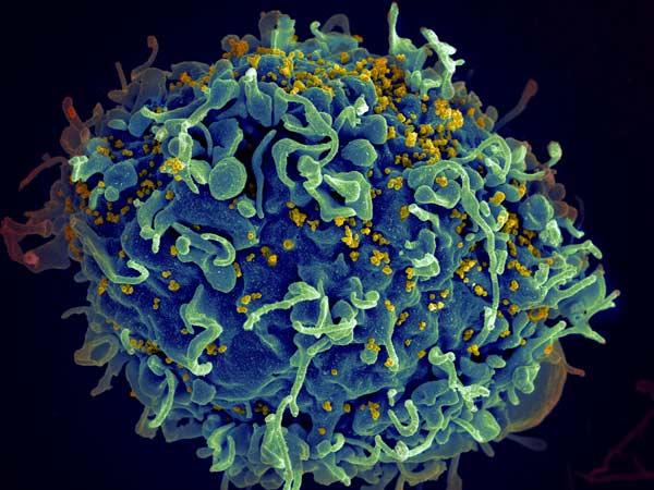 The AIDS Virus Infecting a Human Immune Cell