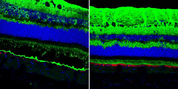 Treating Best Disease with Gene Therapy
