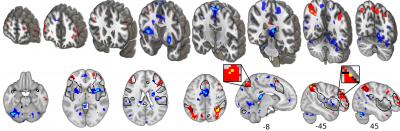 fMRI activity and the placebo effects on construction of pain