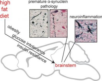 Poor Diet and Parkinson's Disease