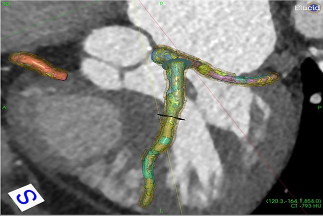 vascuCAP cardiac imaging